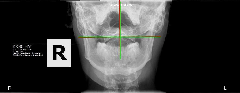 Initial cervical X-ray — subluxation analysis Royal Palm Beach