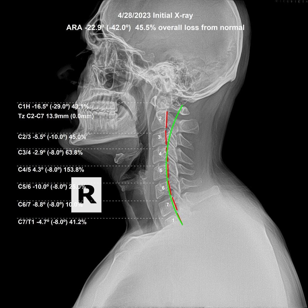 Lateral cervical X-ray before chiropractic correction