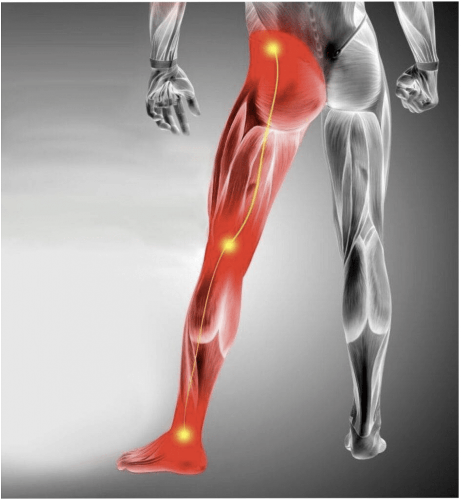 Sciatica anatomy — sciatic nerve compression Royal Palm Beach FL