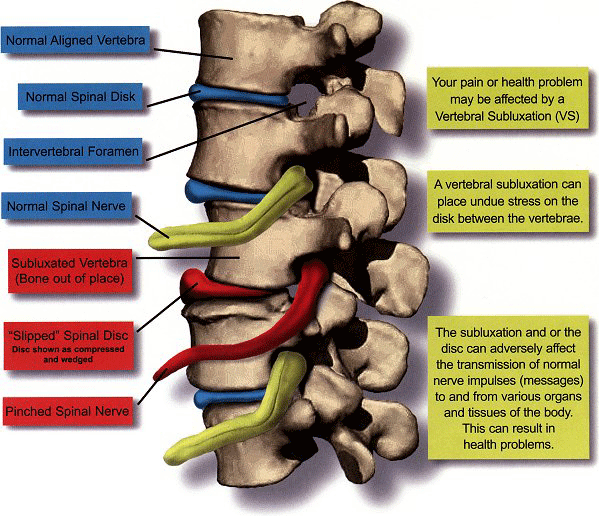 Subluxation animation — vertebral misalignment causing nerve compression