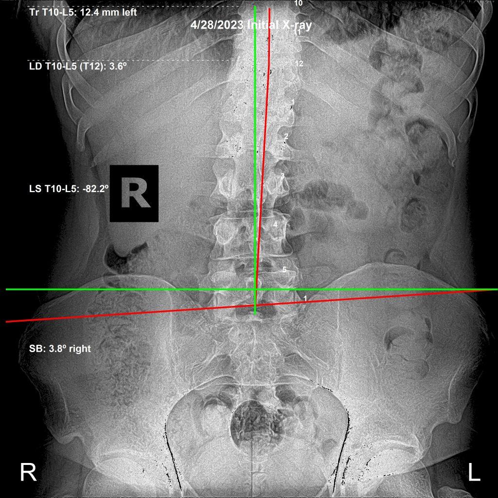 Lumbar spine X-ray with correction analysis