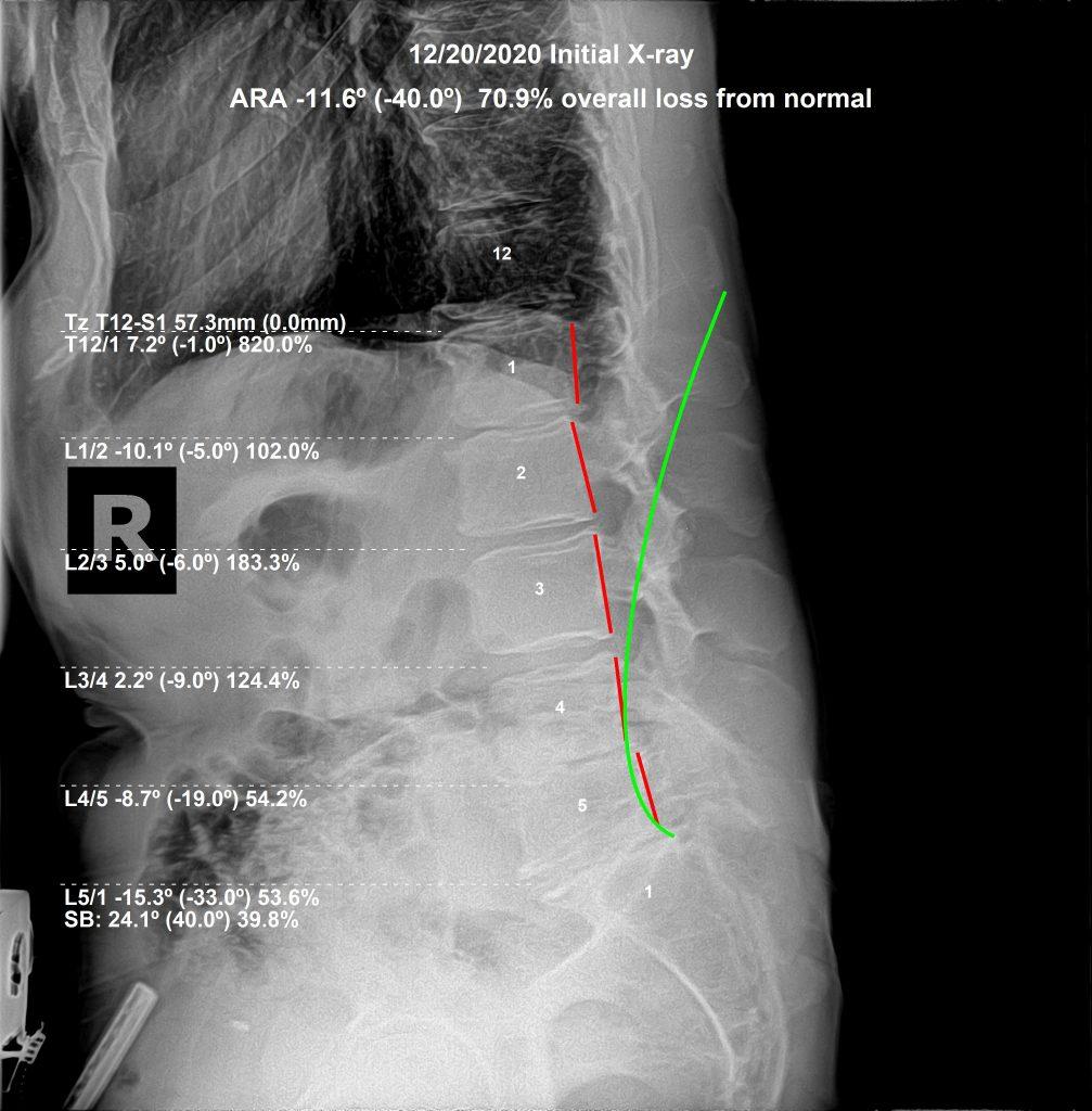 Lumbar spine X-ray with ARA structural analysis