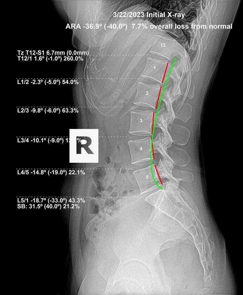 Before lumbar X-ray — reduced lumbar lordosis
