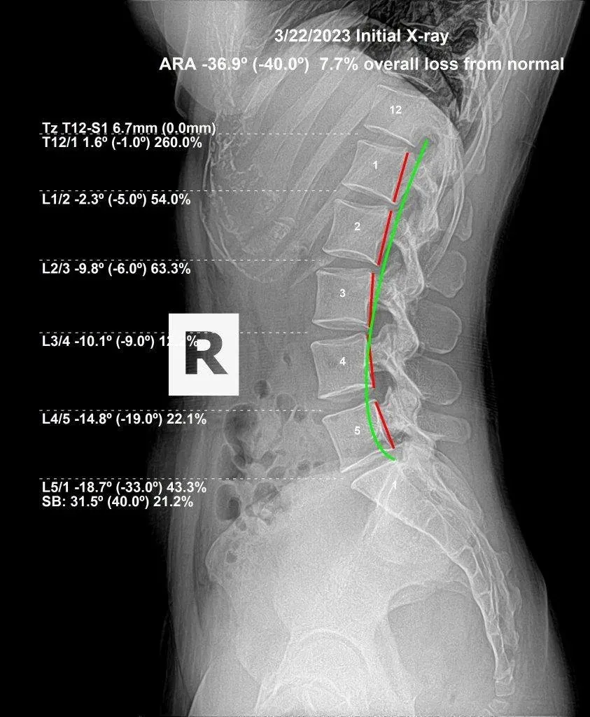 Initial lumbar X-ray showing spinal subluxation — 7.7% loss from normal curve