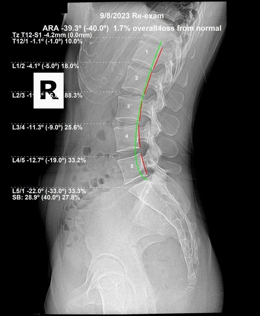 Re-exam lumbar X-ray after subluxation correction — 1.7% loss from normal