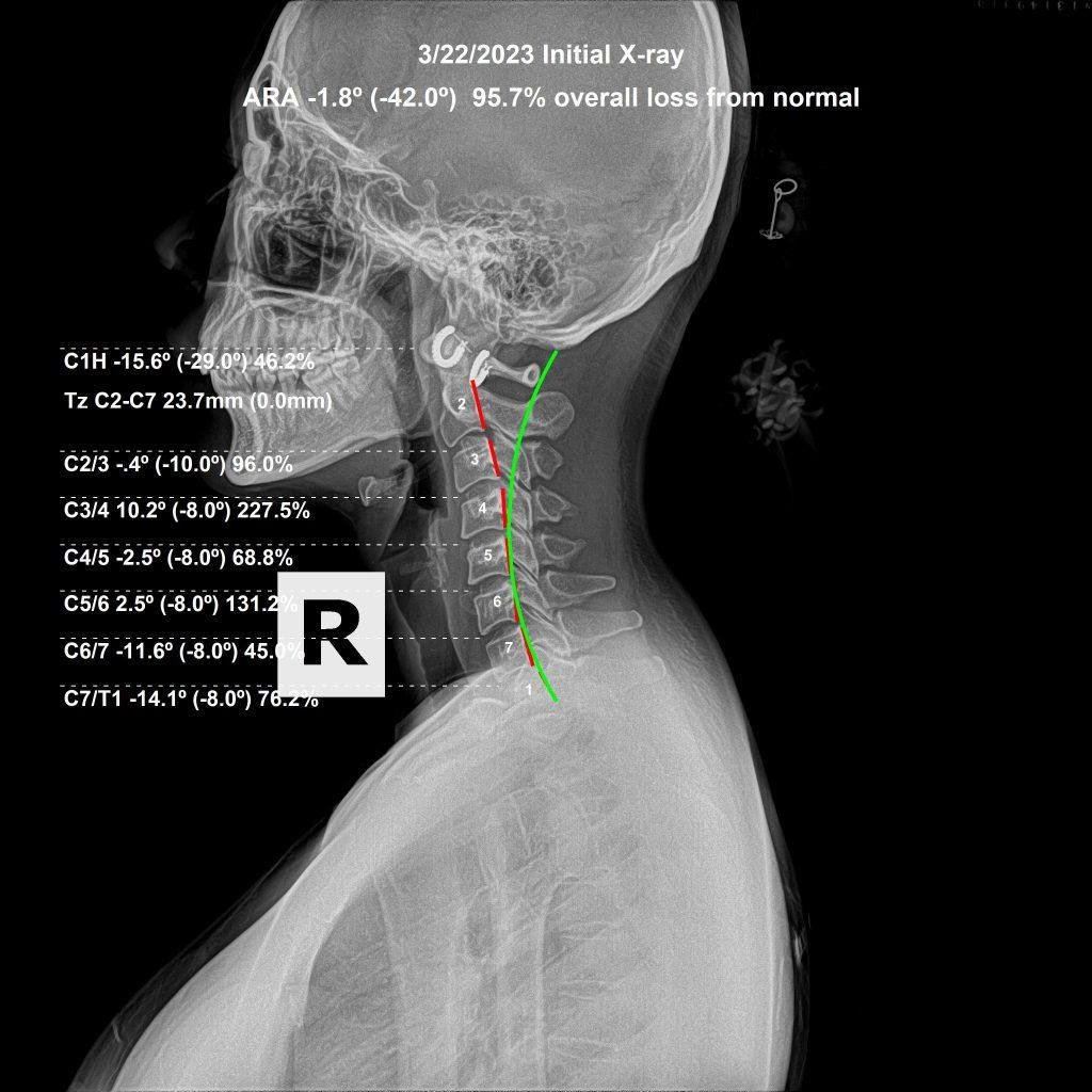 Before cervical X-ray — subluxation present, reduced cervical curve