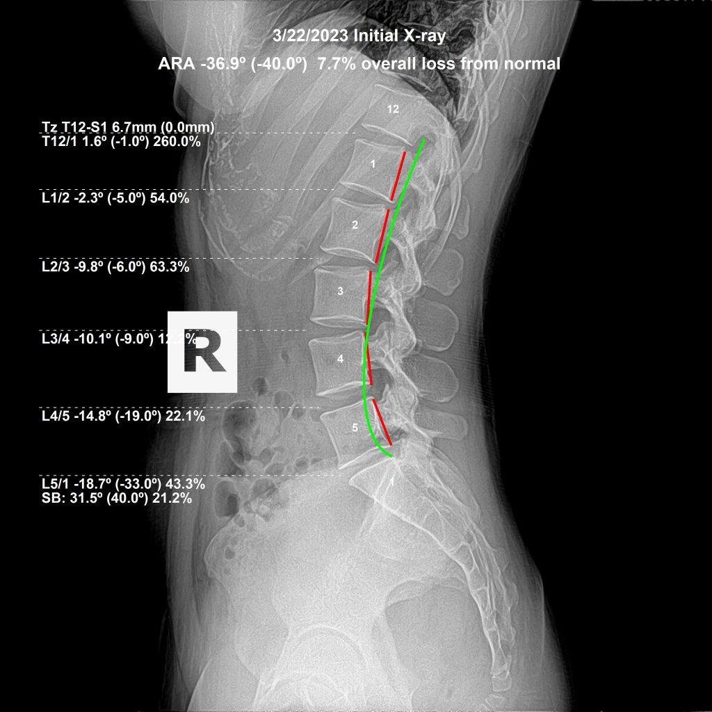 Before chiropractic: lumbar spine lateral X-ray showing subluxation — Royal Palm Beach FL