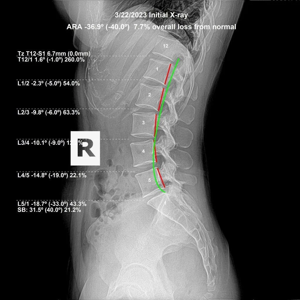 Initial lumbar X-ray showing spinal subluxation — 7.7% loss from normal curve