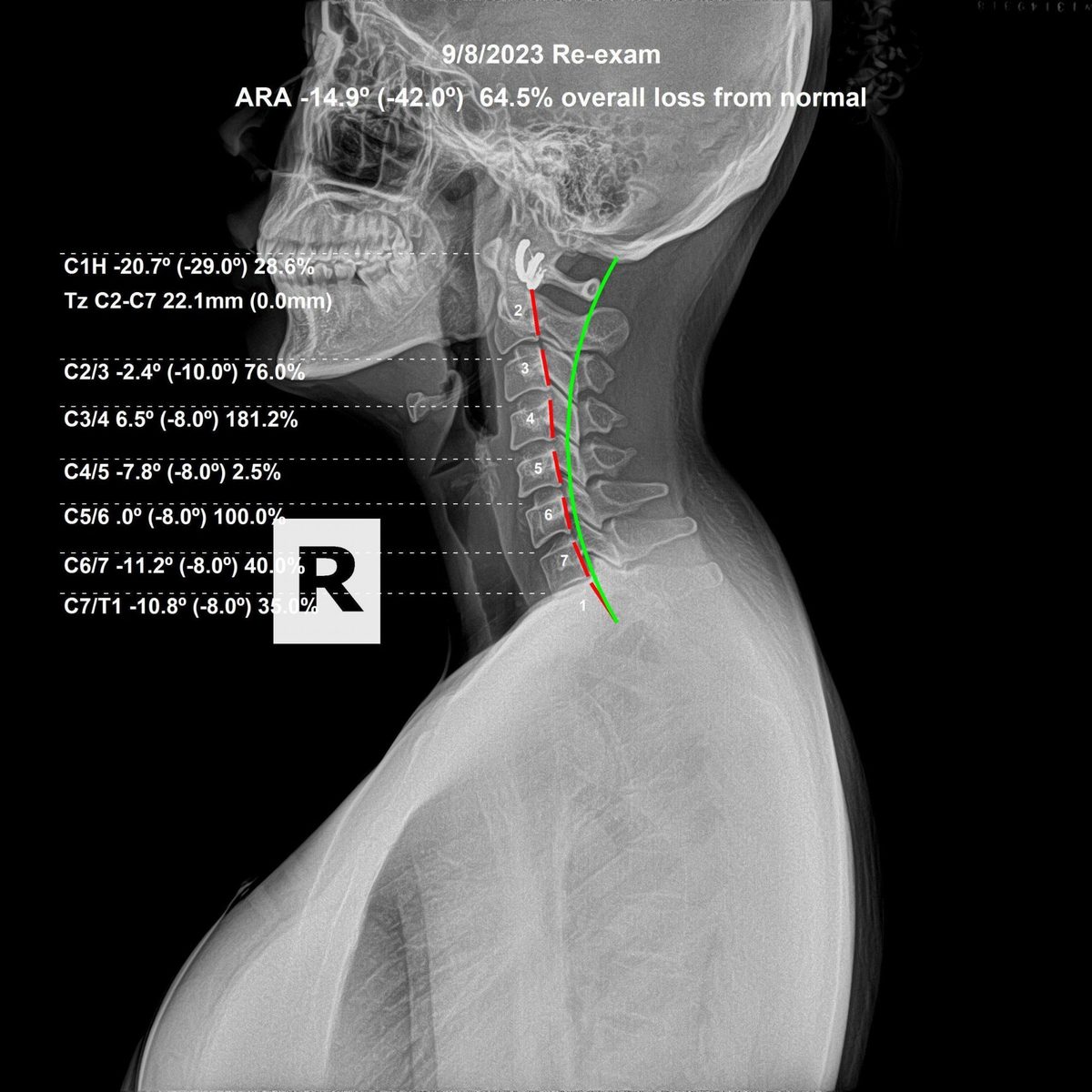 Lateral cervical X-ray showing cervical curve analysis — Rochet Family Chiropractic Royal Palm Beach FL