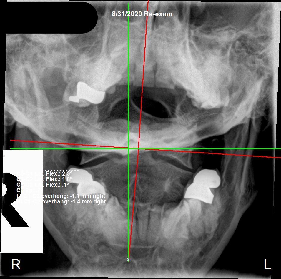 Cervical X-ray before structural correction