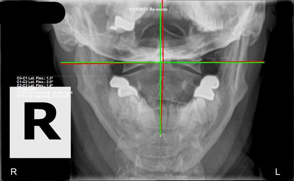 Cervical X-ray after structural correction