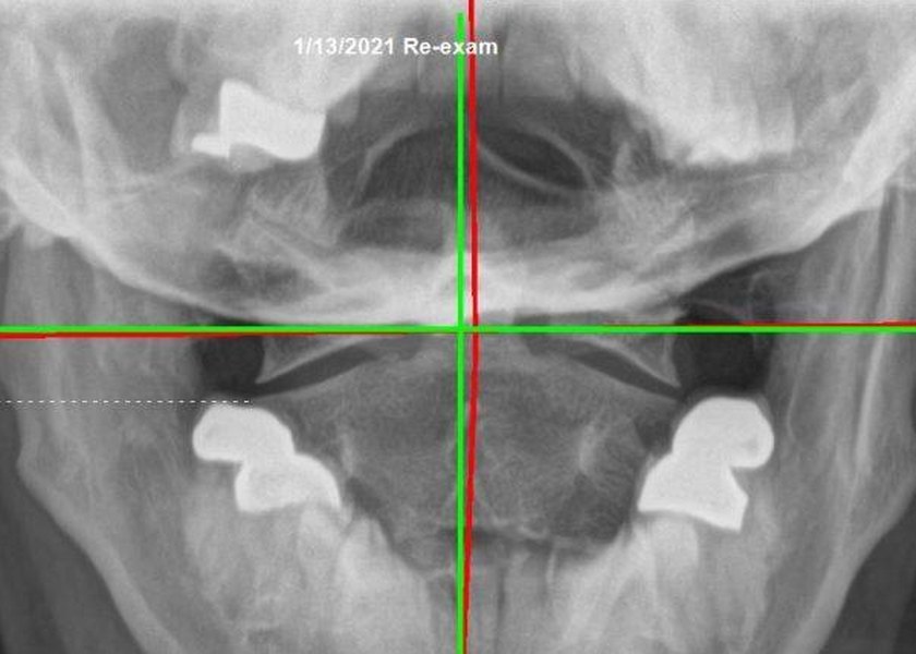 Cervical X-ray after structural correction
