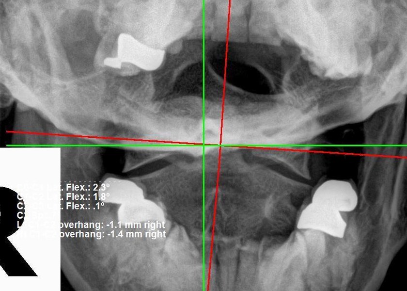 Cervical X-ray before structural correction