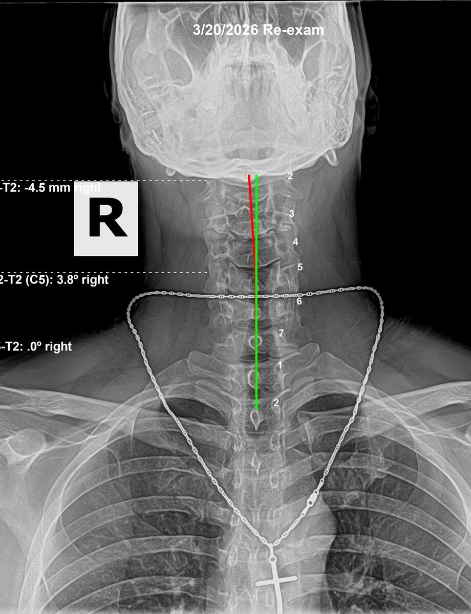 Follow-up cervical AP X-ray showing head tilt corrected to 0mm after 12 weeks of chiropractic correction, March 20 2026, Rochet Family Chiropractic Royal Palm Beach