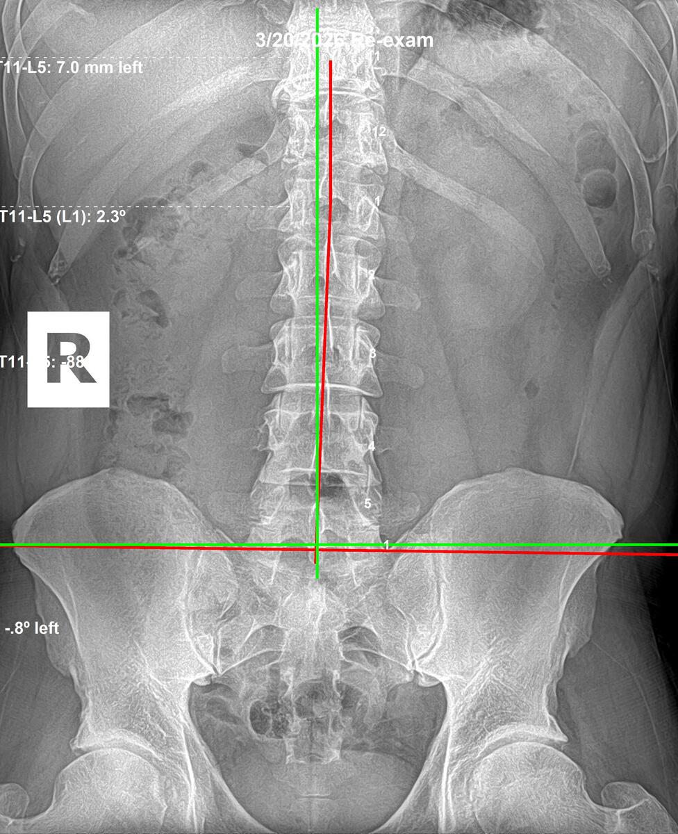 Follow-up lumbar AP X-ray showing left AI sacrum corrected from 2.3 degrees to 0.8 degrees after 12 weeks, March 20 2026, Rochet Family Chiropractic Royal Palm Beach