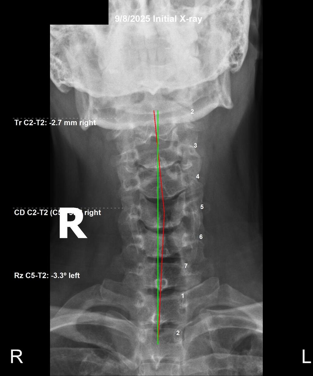 Initial cervical AP X-ray showing 2.7mm right head tilt and subluxation at C2, September 8 2025, Rochet Family Chiropractic Royal Palm Beach