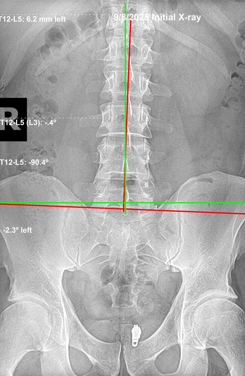 Initial lumbar AP X-ray showing left anterior inferior sacrum at 2.3 degrees, September 8 2025, Rochet Family Chiropractic Royal Palm Beach